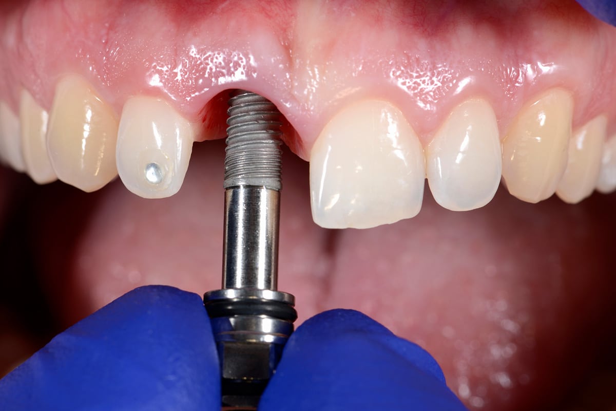 Dental Implants